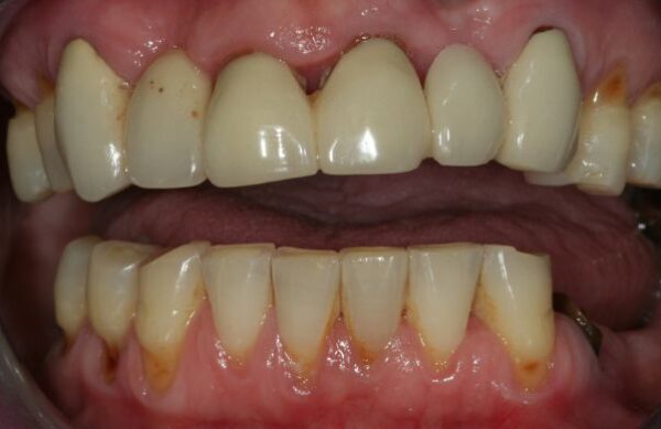 Before - Staly  Dental