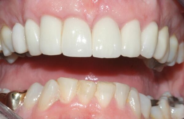 After - Staly Dental