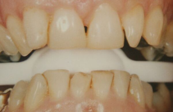 Before - Staly  Dental