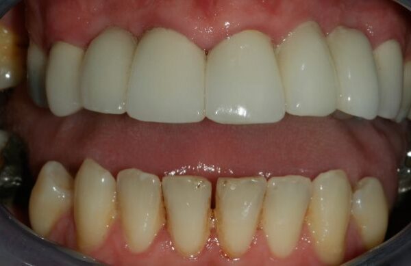 After - Staly Dental