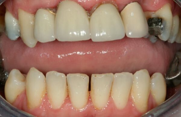 Before - Staly  Dental