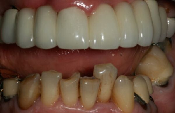 After - Staly Dental