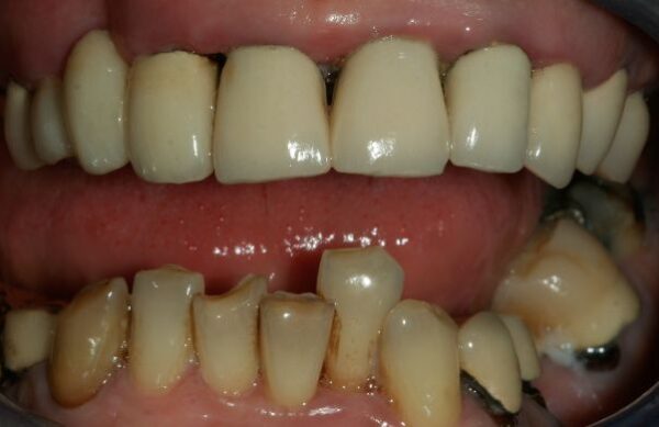 Before - Staly  Dental
