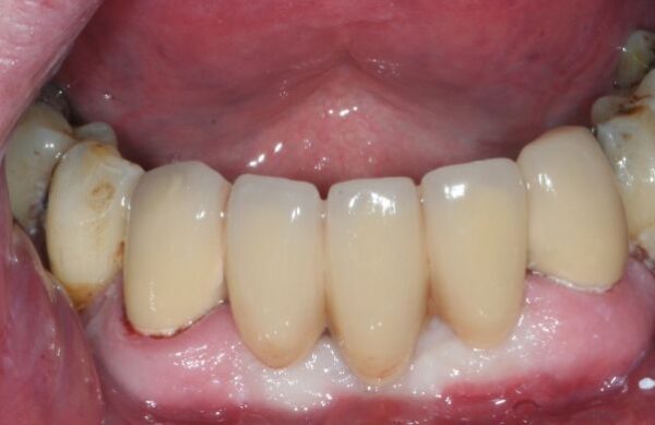 After - Staly Dental
