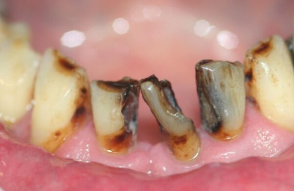 Before - Staly  Dental