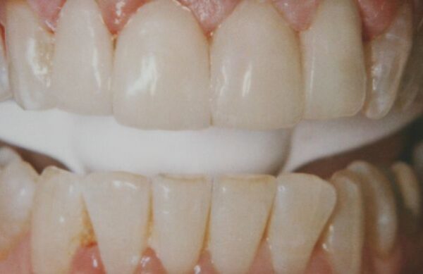 After - Staly Dental