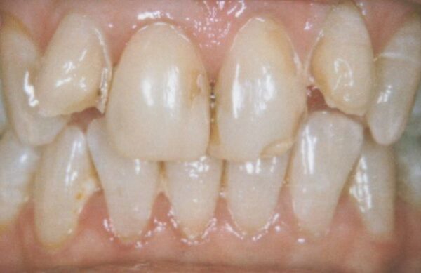 Before - Staly  Dental