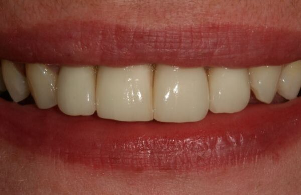 After - Staly Dental