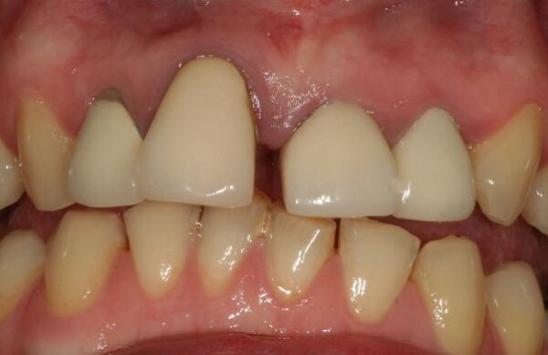 Before - Staly  Dental