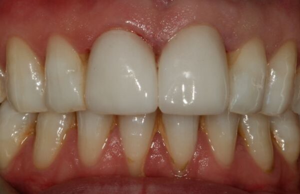 After - Staly Dental