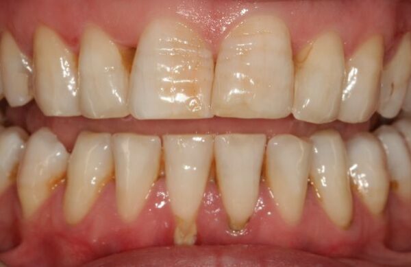 Before - Staly  Dental