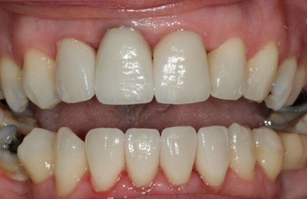 After - Staly Dental