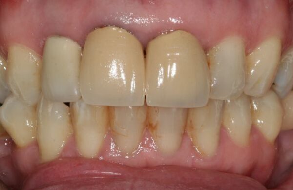 Before - Staly  Dental
