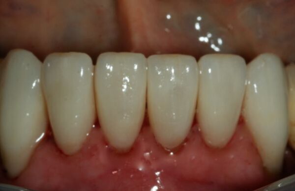 After - Staly Dental