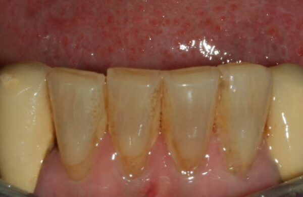 Before - Staly  Dental