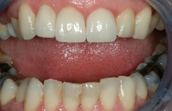 After - Staly Dental