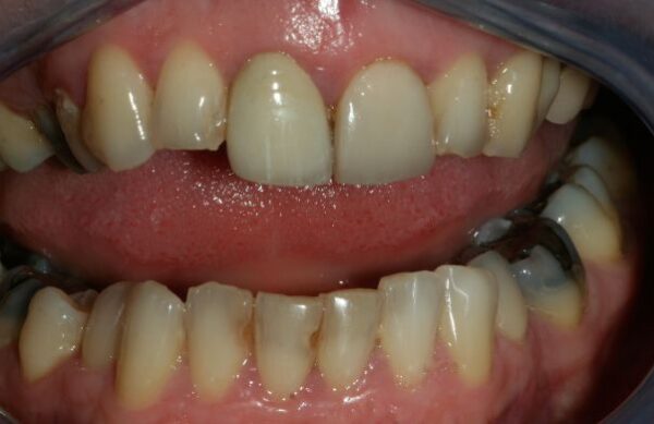 Before - Staly  Dental