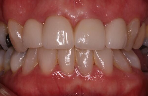 After - Staly Dental