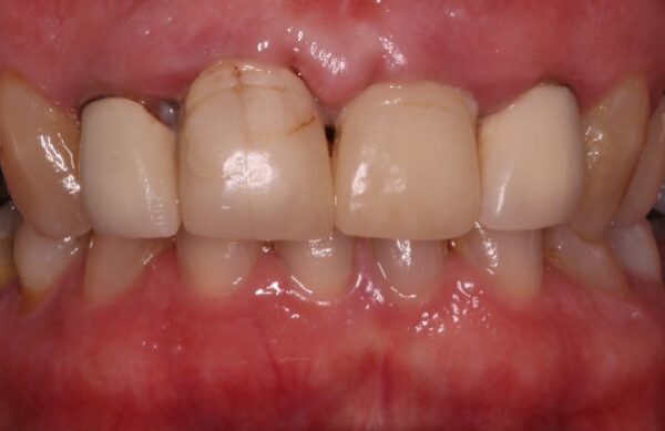 Before - Staly  Dental