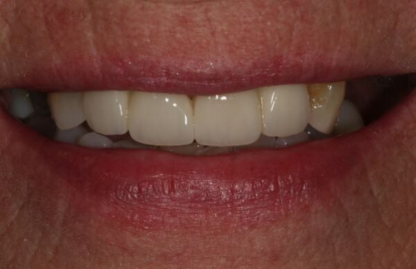 After - Staly Dental