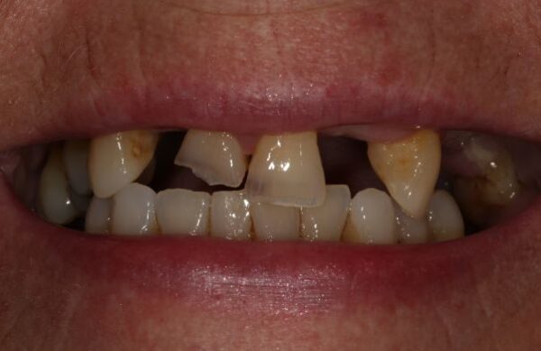 Before - Staly  Dental