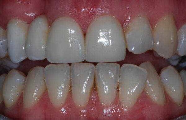 After - Staly Dental