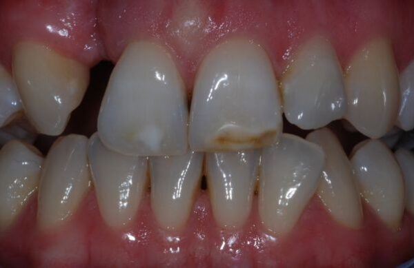 Before - Staly  Dental