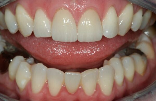 After - Staly Dental