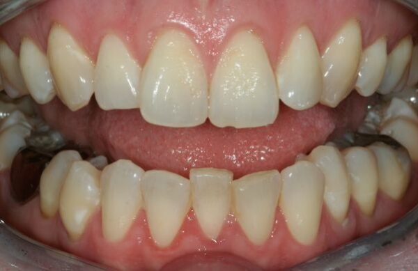 Before - Staly  Dental