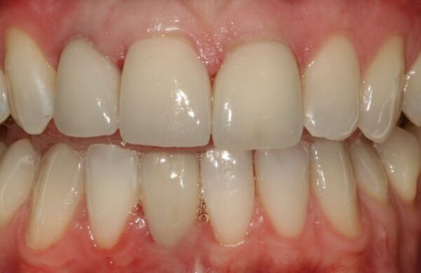 After - Staly Dental