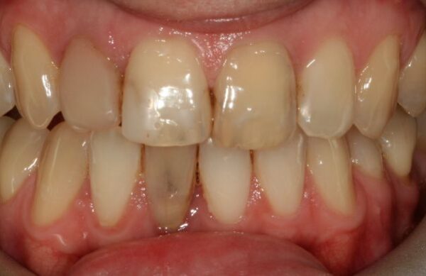 Before - Staly  Dental